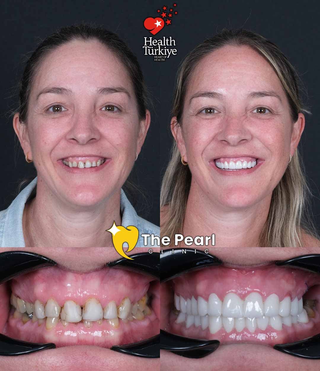 Zirconia crown smile makeover case at The Pearl Clinic Antalya